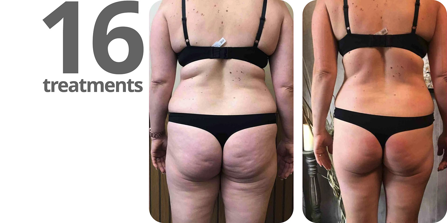 ba-redlight-back-16treatments