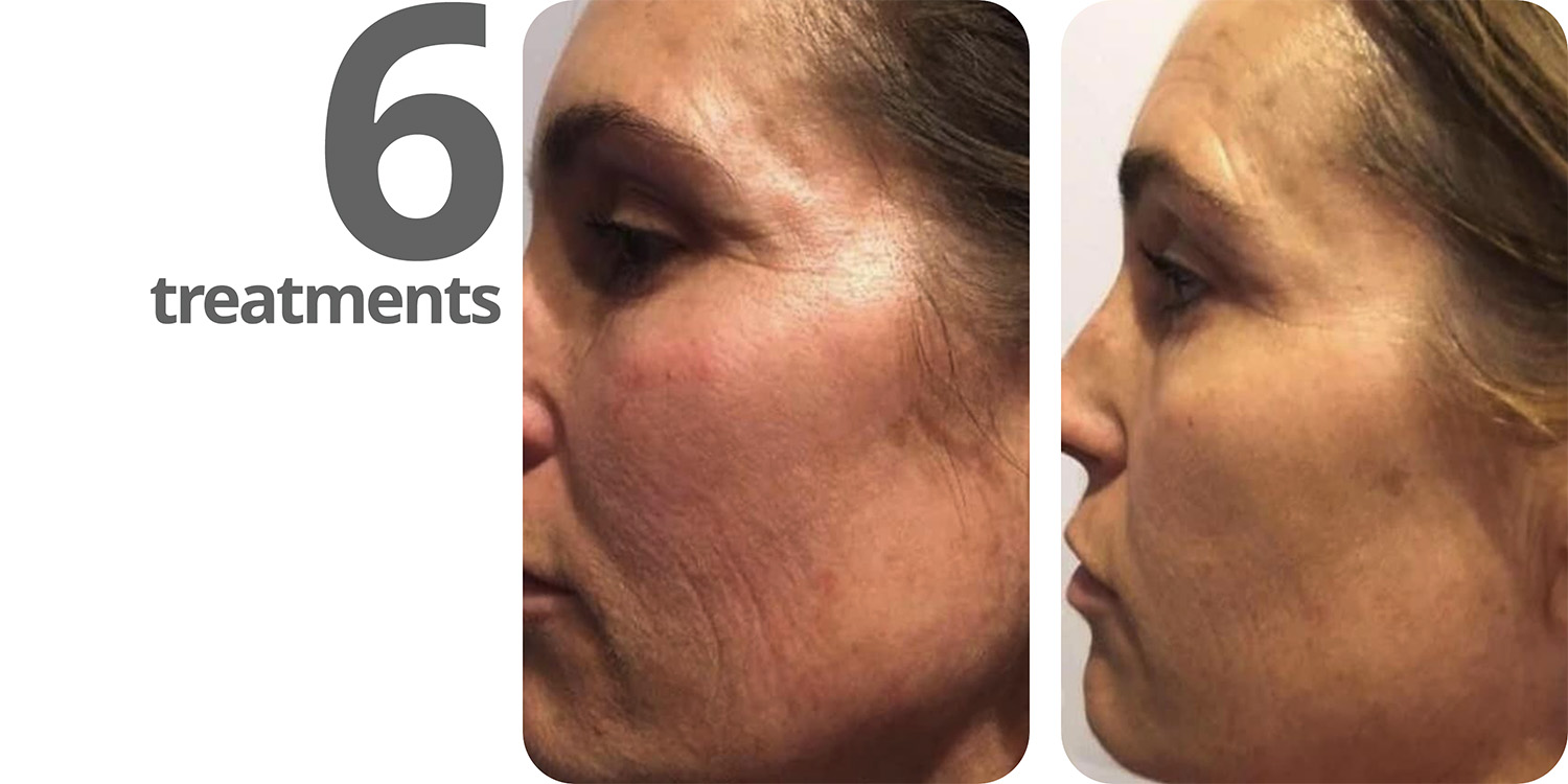 ba-redlight-face-left-6treatments