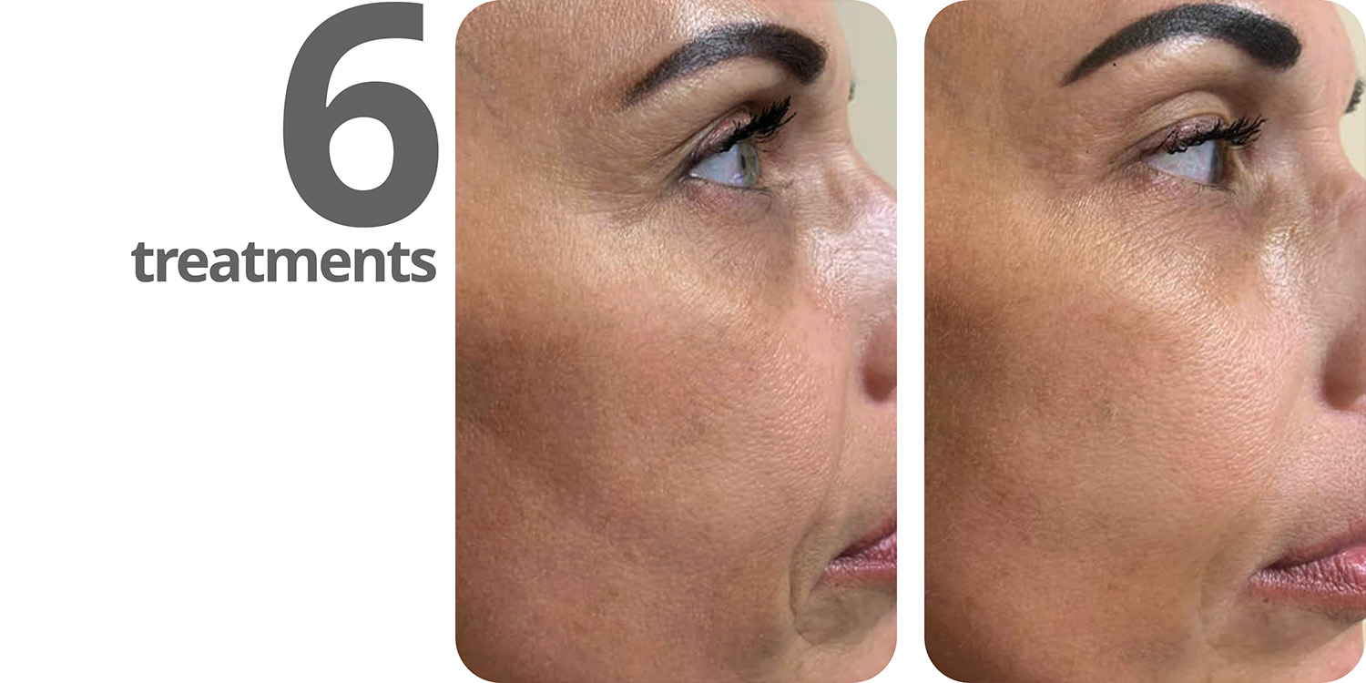 ba-redlight-face-right-6treatments