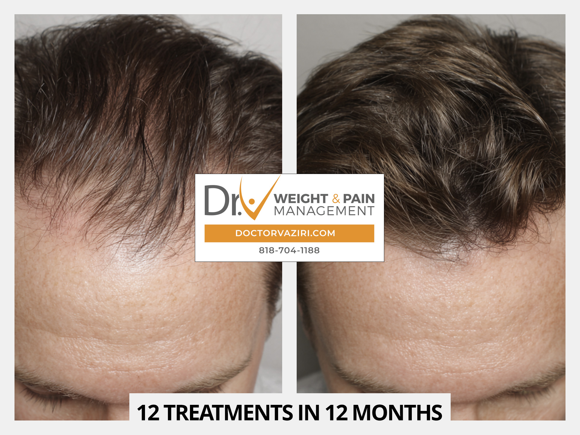 Before/after close-up of hair on the forehead showing improved density after a treatment; branding for DoctorVaziri.com at the center.